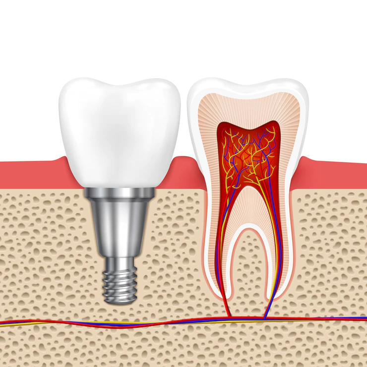 implantes dentários